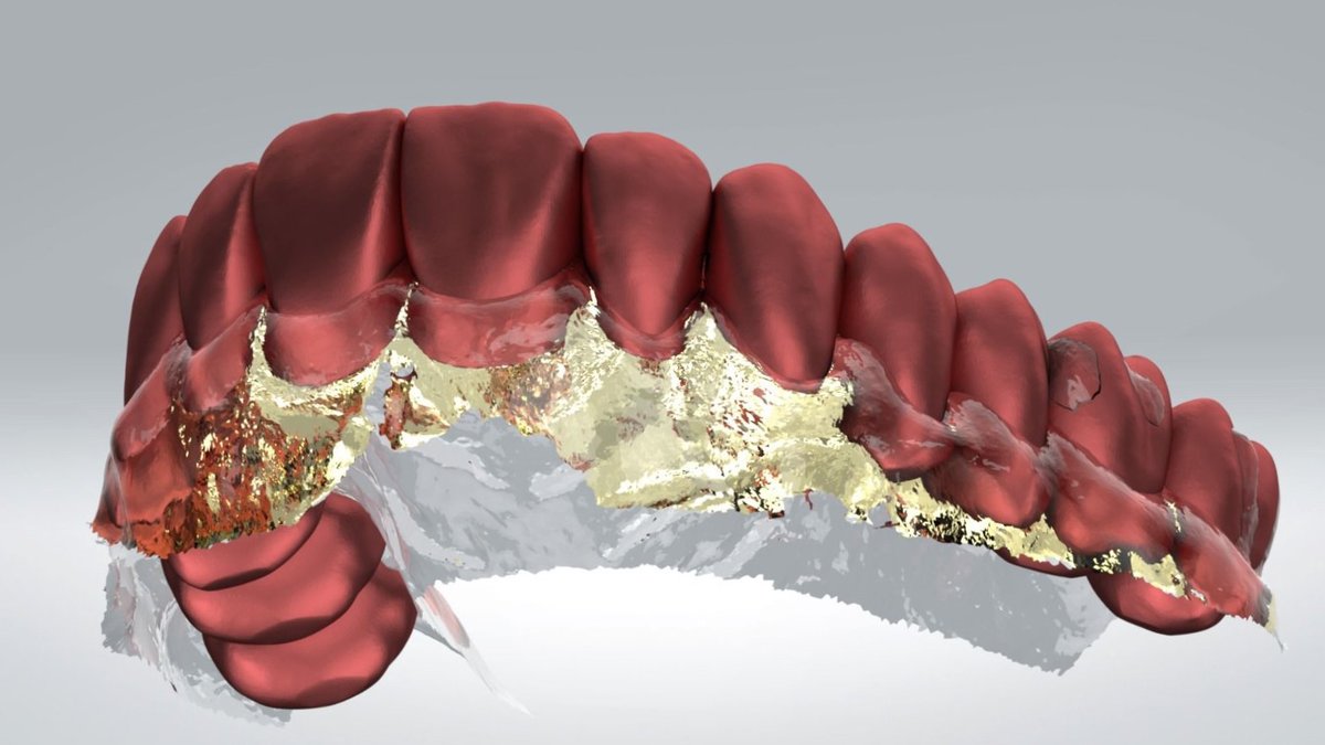 Enceramento digital 3D — a simulação do sorriso na tela